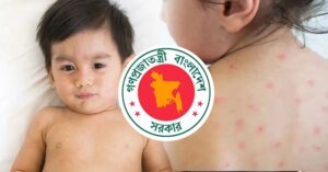 হামের থাবায় প্রাণ গেল আরও সাত জনের